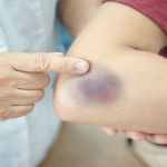 Memar Ungu yang Tiba-Tiba Muncul pada Wanita, Sebenarnya Apa Penyebabnya?